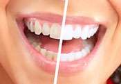 Whitening Teeth – What You Need To Know